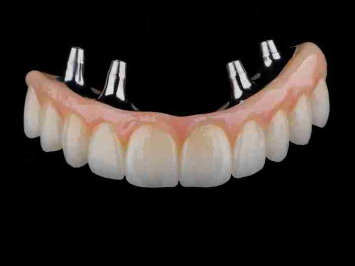 Full-arch zirconia prosthesis on a titanium bar for All-on-X implants